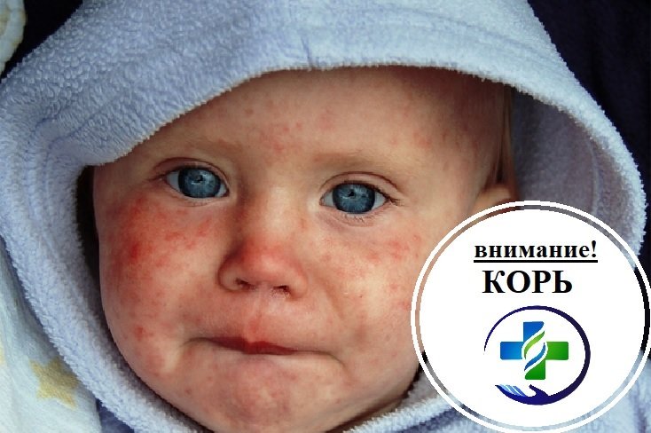 Зафиксирована вспышка кори